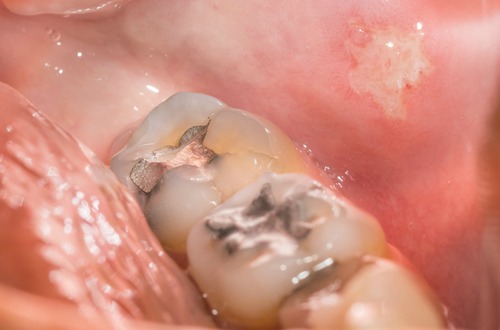 silver filling teeth m