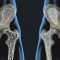 osteoporosis M