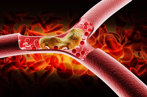 cholesterol-blocked-artery