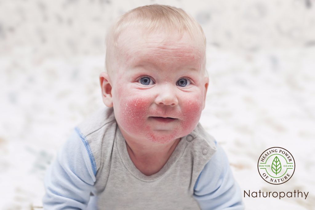 atopic dermatitis