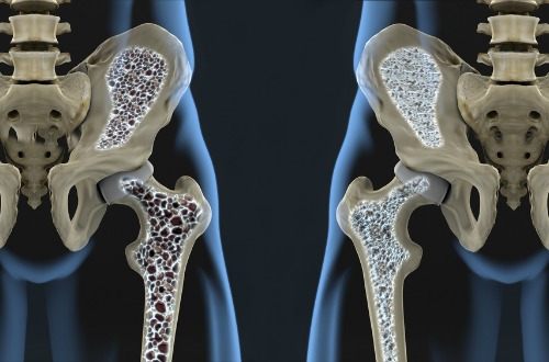 osteoporosis M
