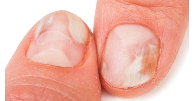 爪水虫 爪の変色や分厚さが変化 変色の原因や予防と完治に向けた治療をご紹介 ドクターサプリusa