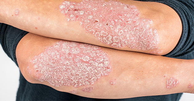 乾癬が精神的健康に与える影響